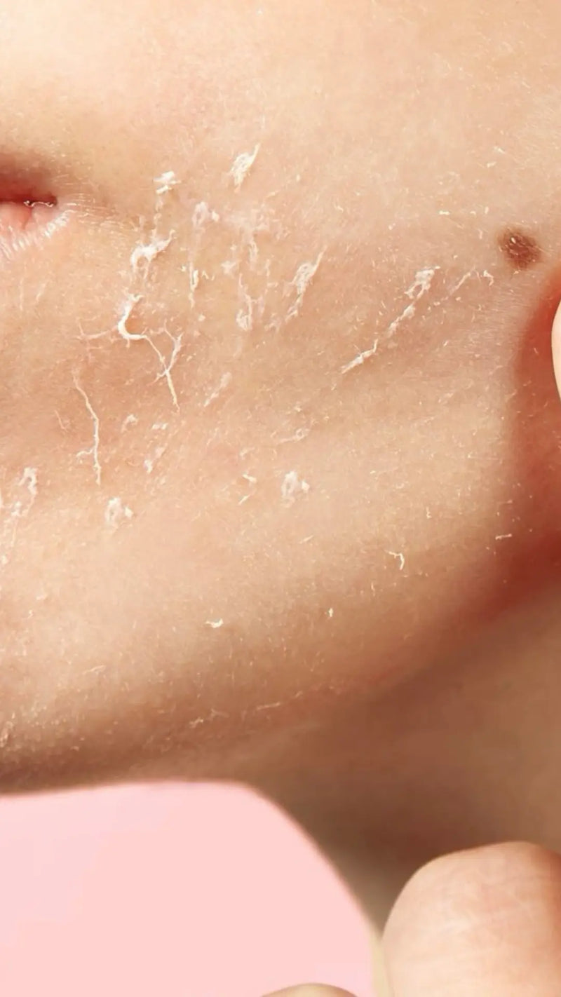 Dry skin