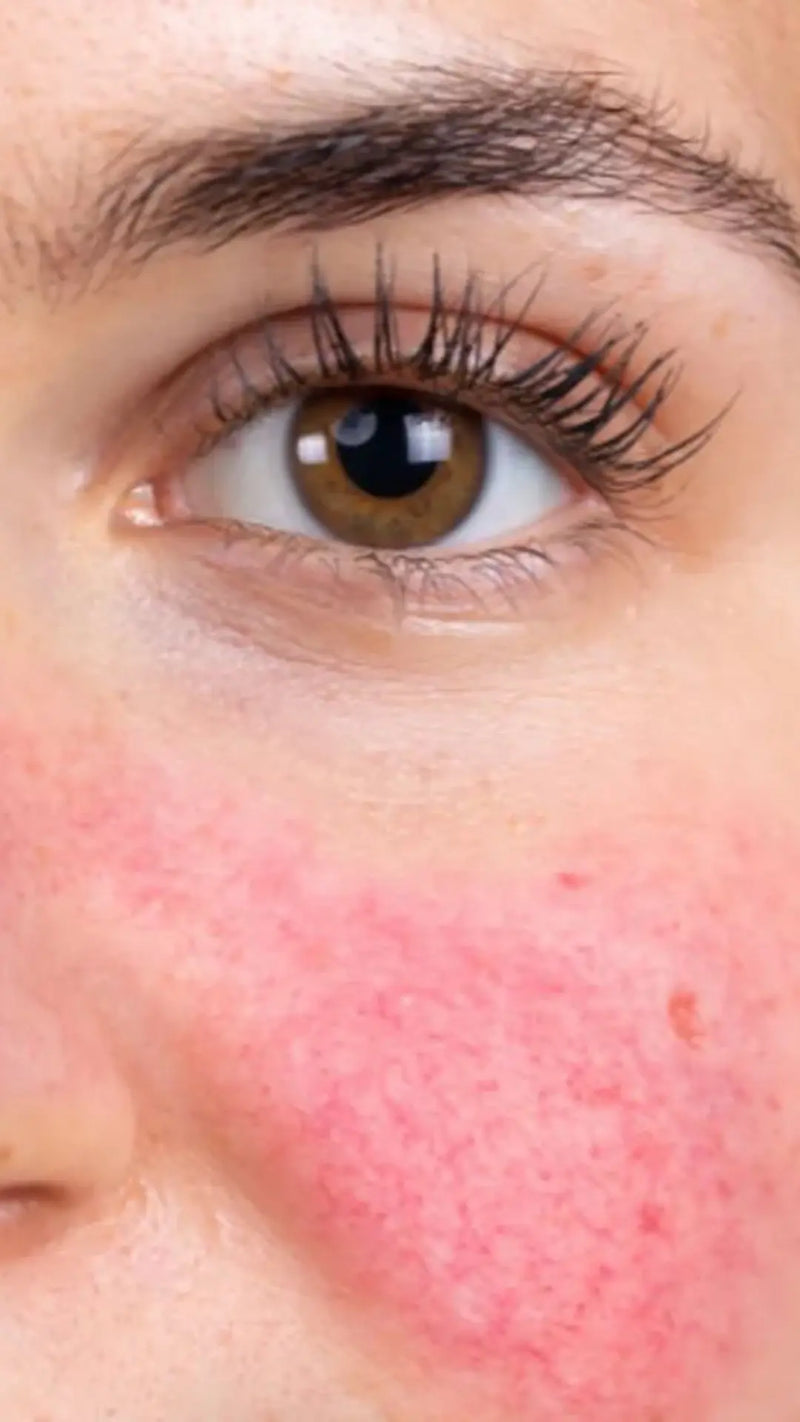 Redness