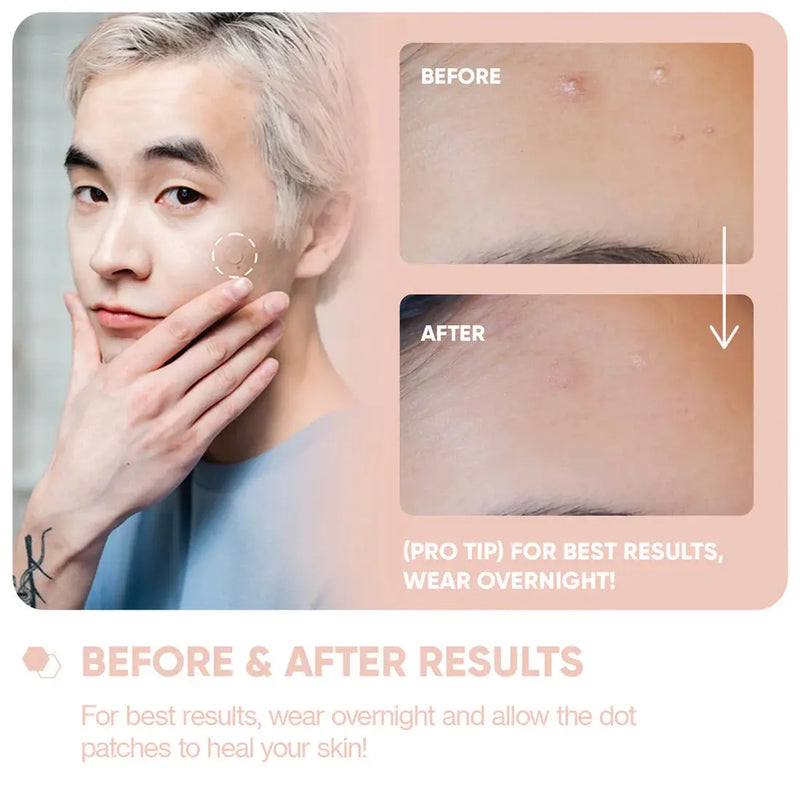 BreakoutAid Emergency Dots For Spots and Blemishes Salicylic Acid