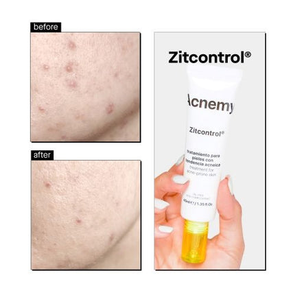 Acnemy Zitcontrol Treatment Cream